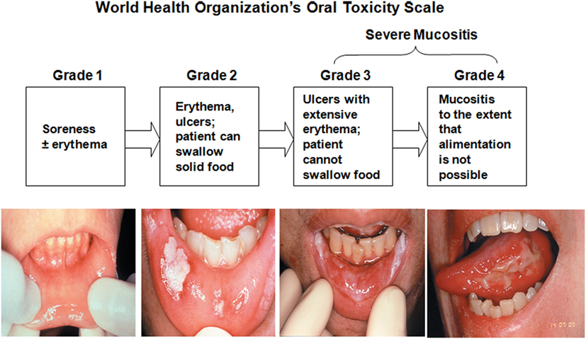 Mucositis WHO Oral's toxicity Scale