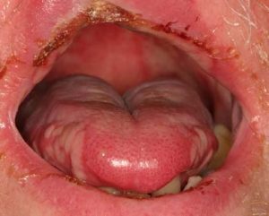 Oral Mucositis